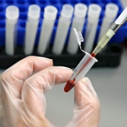 Ученые открыли новый агрессивный штамм вируса иммунодефицита человека